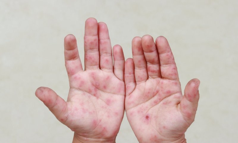 כמעט 3000 מאומתים מתחילת התפרצות החצבת - אלו המוקדים