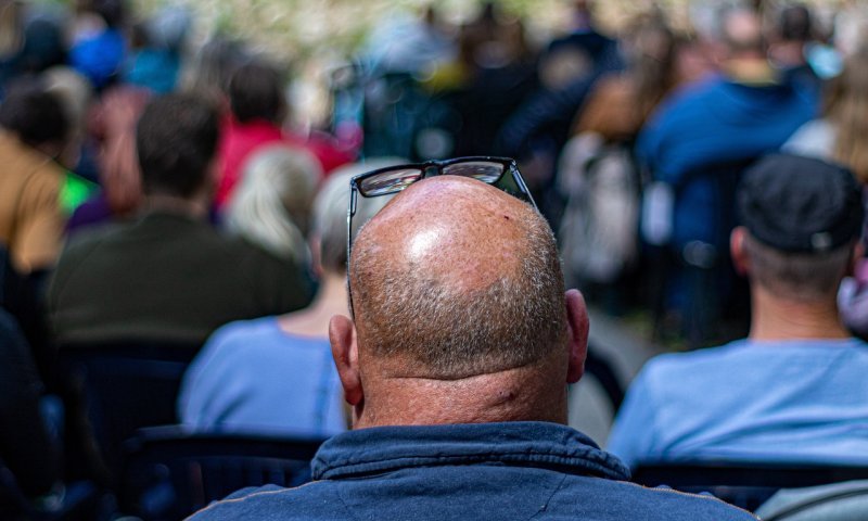 הנשיא הכריז על מאבק נגד התקרחות - זו הסיבה