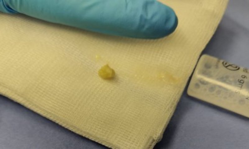 הגיעה לכדי סכנת חיים: בת שנתיים שאפה לדרכי הנשימה חתיכת שקד, וניצלה ברגע האחרון