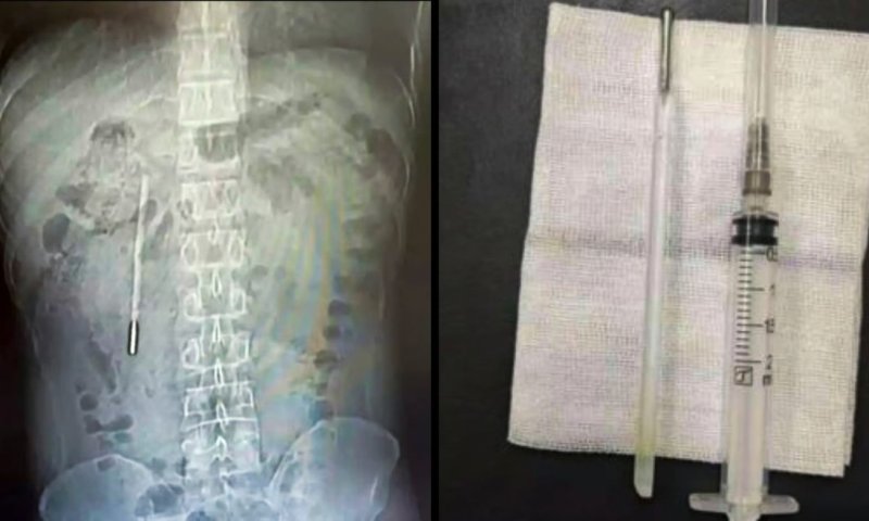 תעלומה בבטן: סיני חי עם מדחום בתוך גופו במשך שני עשורים