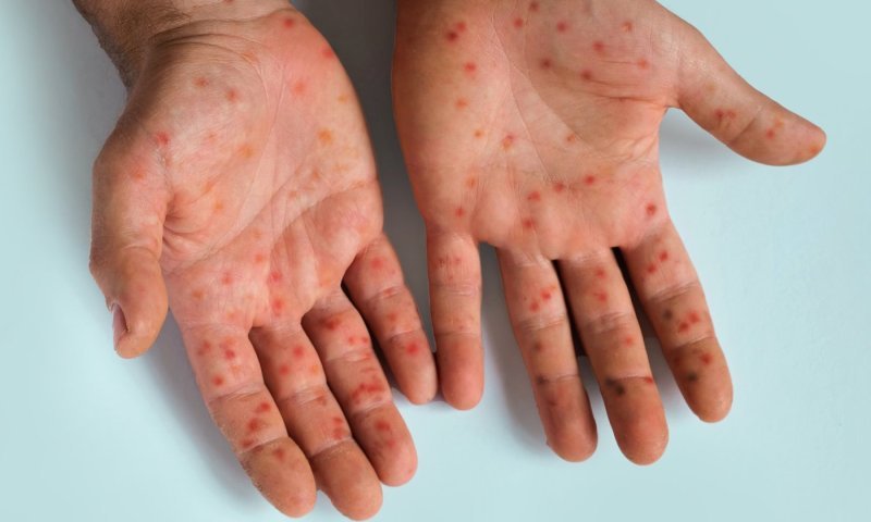 חולה חצבת התפלל בבית הכנסת המרכזי בשיכון ה בבני ברק