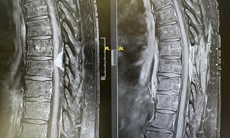 נשים שסבלו משיתוק כמעט מלא של הרגליים, הצליחו לחזור לתפקוד מלא